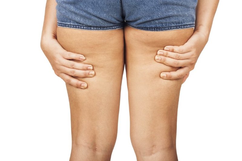 Causes de l'apparition de la cellulite