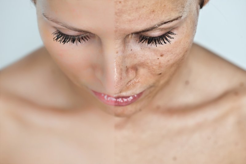 Masker voor ouderdomsvlekken