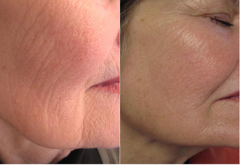 Ptosis Correction 5 traitements