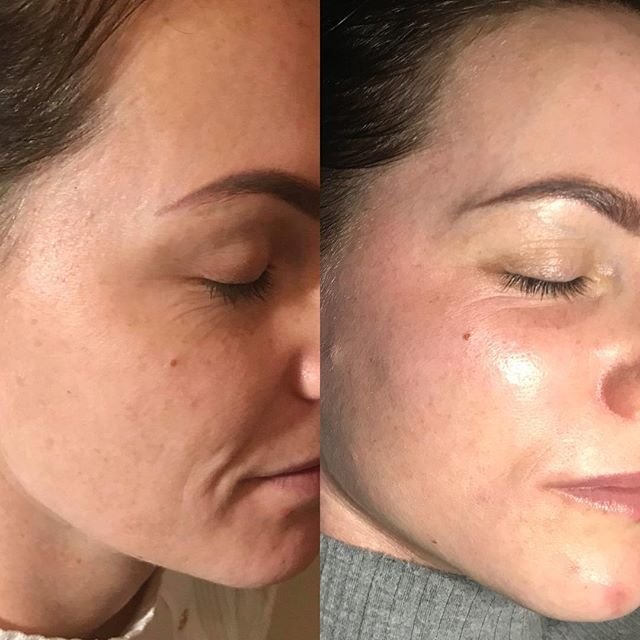 Effet peeling Prx-t33: avant et après les photos