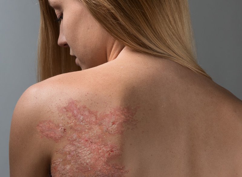 Psoriasis op het lichaam