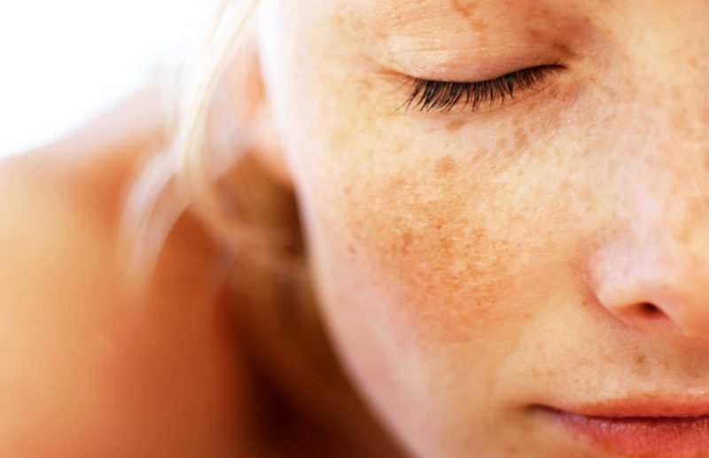 Fille avec chloasma sur son visage.