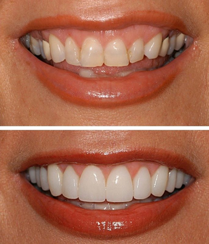 Perfect Smile Veneers Veneers: Avant et après