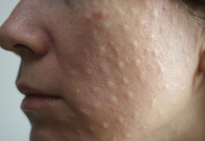 Papules après bio-revitalisation