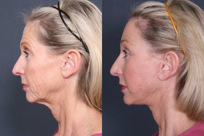 Facelift circular