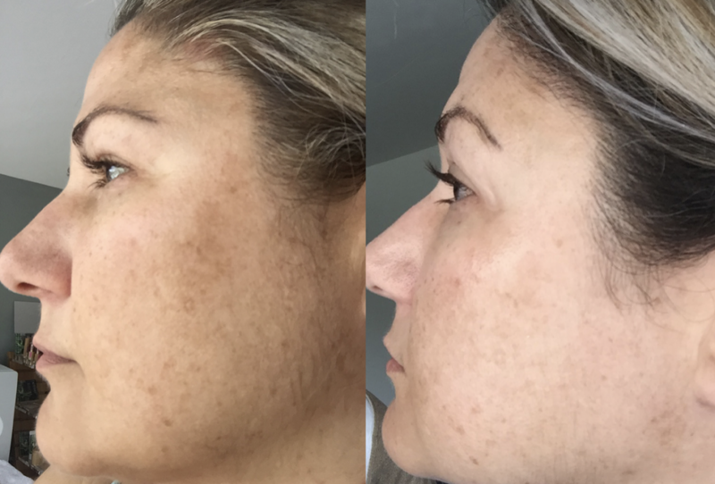 Peeling-effect prx-t33: foto voor en na vier procedures