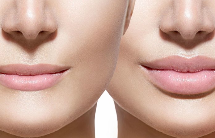 Lipvergroting: wat gebeurt er na de procedure?