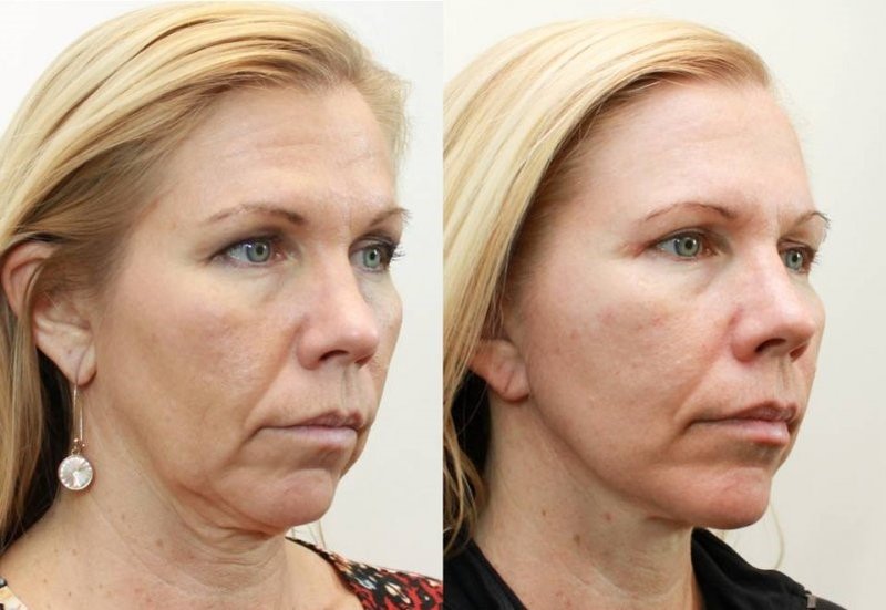 Visage avant et après la bio-revitalisation