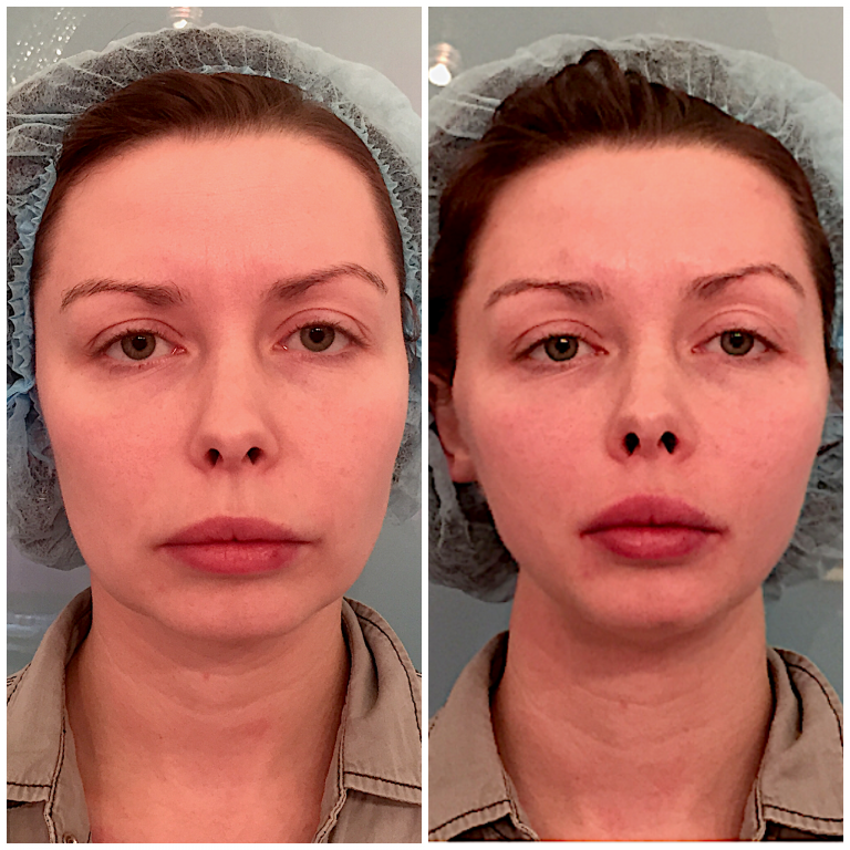 Thread facelift: voor en na foto's