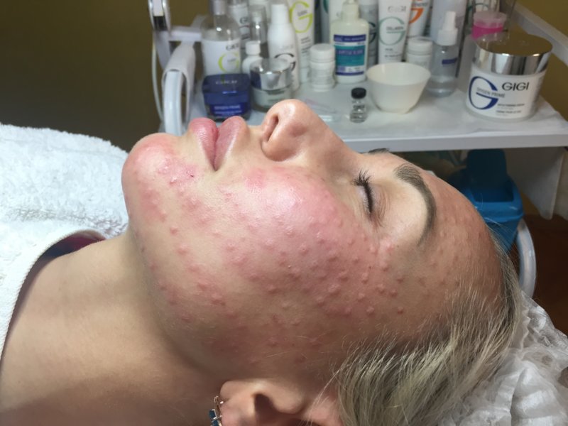 Papules sur le visage après la procédure