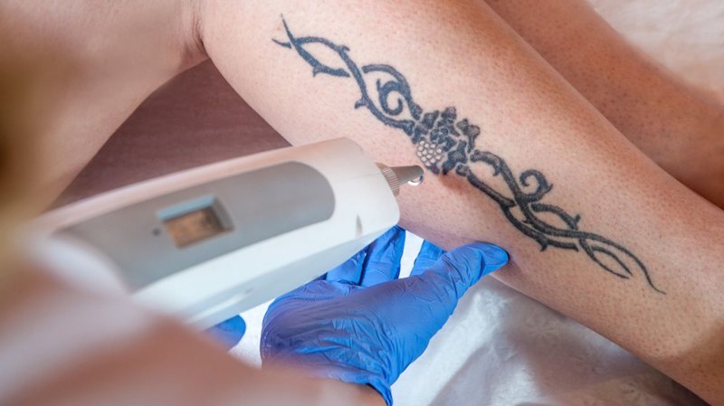 Le processus de suppression du tatouage